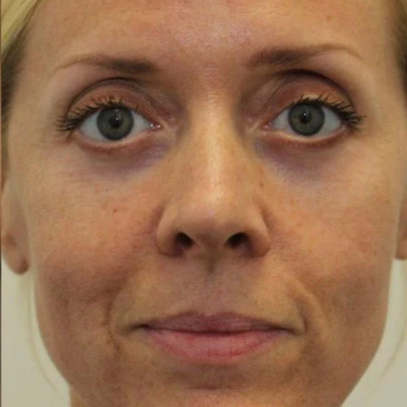 Kit Infusione Micro-Needling Antiage