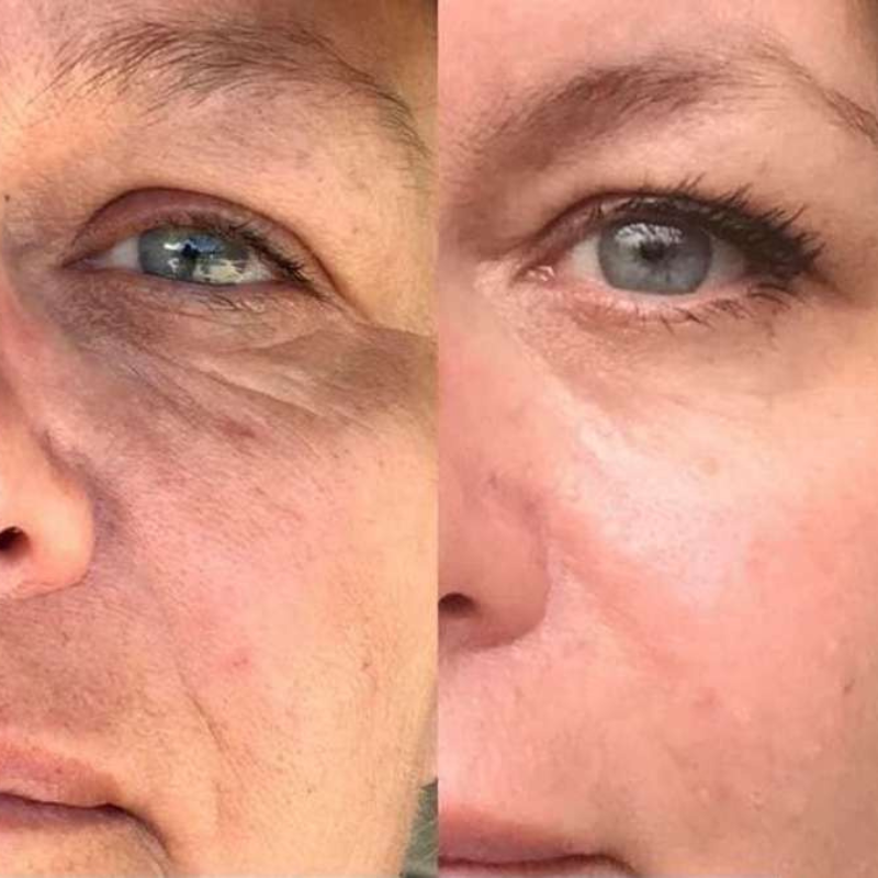 Kit Infusione Micro-Needling Antiage