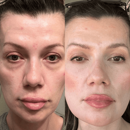 Kit Infusione Micro-Needling Antiage