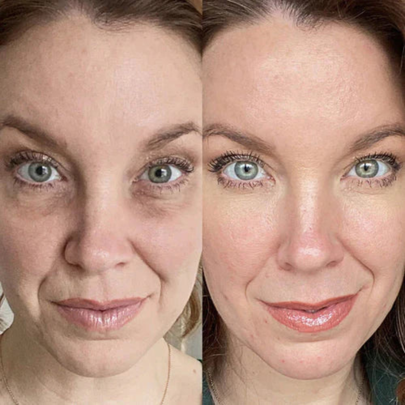 Kit Infusione Micro-Needling Antiage